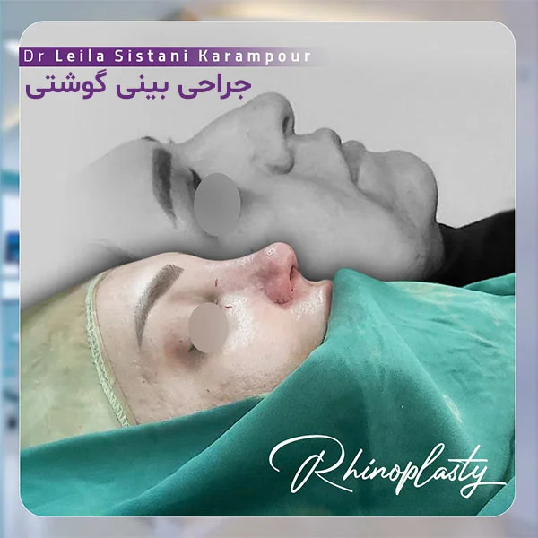 جراحی بینی گوشتی - دکتر لیلا سیستانی کرم پور