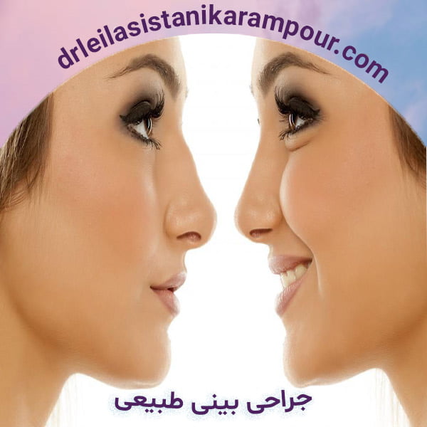 جراحی بینی طبیعی - دکتر لیلا سیستانی کرم پور