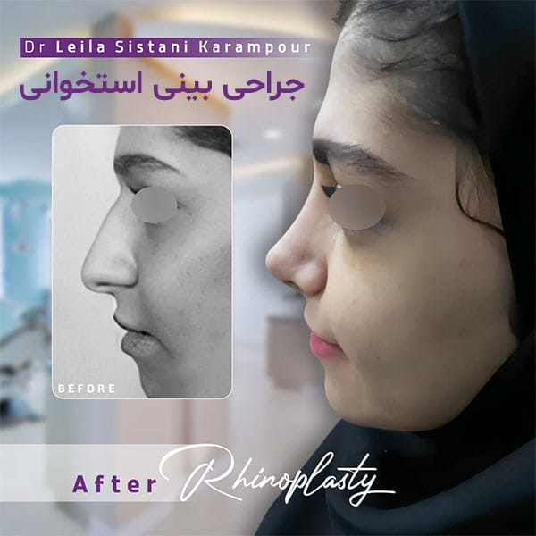 جراحی بینی استخوانی -دکتر لیلا سیستانی کرم پور