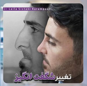 نمونه کار جراحی بینی دکتر لیلا سیستانی کرم پور 
