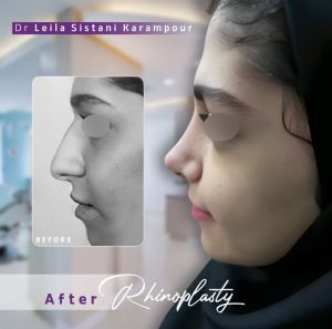 نمونه کار جراحی بینی دکتر لیلا سیستانی کرم پور 