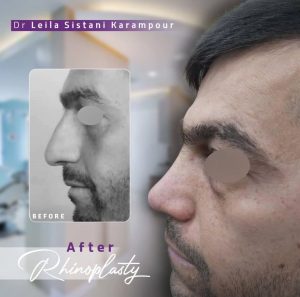 نمونه کار جراحی بینی دکتر لیلا سیستانی کرم پور 