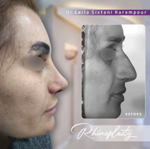 نمونه کار جراحی بینی دکتر لیلا سیستانی کرم پور 