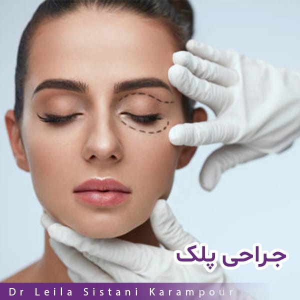 بلفاروپلاستی - دکتر لیلا سیستانی کرم پور