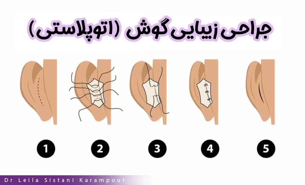 جراحی زیبایی گوش (اتوپلاستی) - دکتر لیلا سیستانی کرم پور