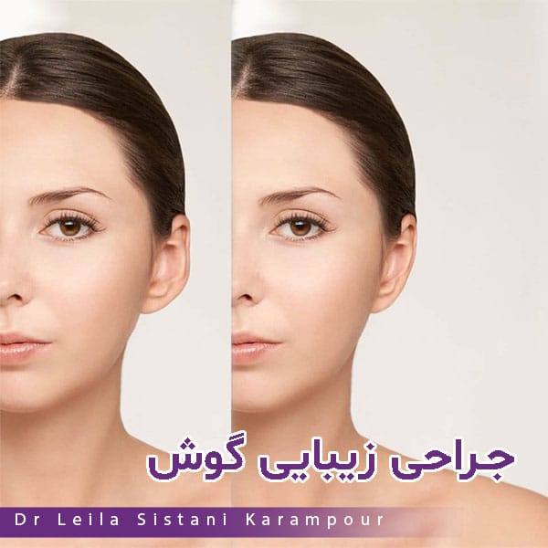 جراحی زیبایی گوش (اتوپلاستی) - دکتر لیلا سیستانی کرم پور