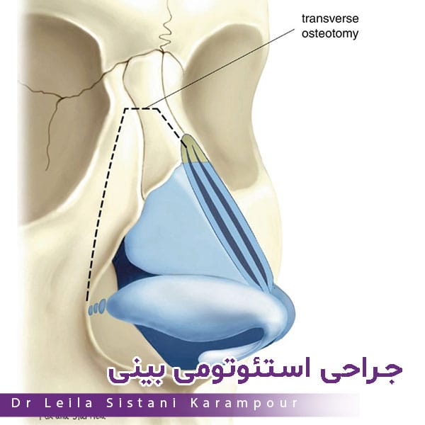 جراحی استئوتومی بینی - دکتر لیلا سیستانی کرم پور