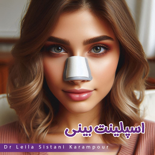 اسپلینت بینی - دکتر لیلا سیستانی کرم پور https://drleilasistanikarampour.com/