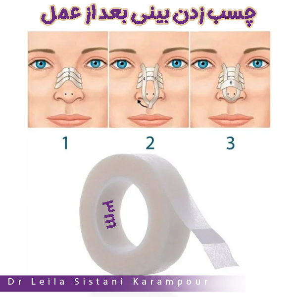 چسب زدن بینی بعد از جراحی- دکتر لیلا سیستانی کرم پور https://drleilasistanikarampour.com/