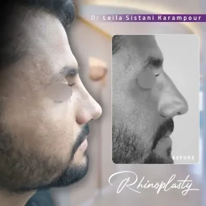 عمل بینی ترمیمی _ دکتر لیلا سیستانی
