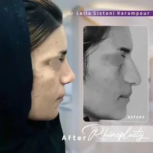 عمل بینی ترمیمی _ دکتر لیلا سیستانی