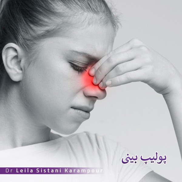 درمان پولیپ بینی _ دکتر لیلا سیستانی