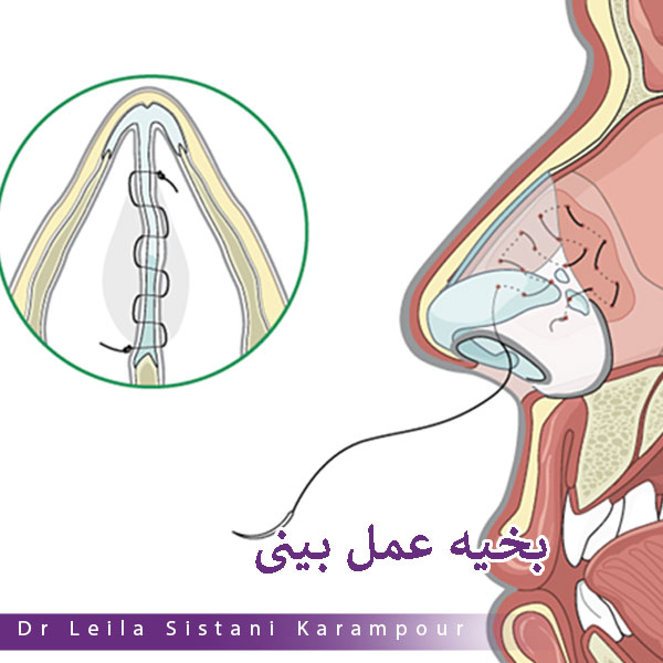 انواع بخیه عمل بینی _ دکتر لیلا سیستانی