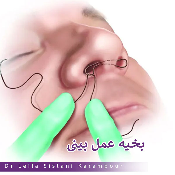 بخیه جراحی بینی _ دکتر لیلا سیستانی