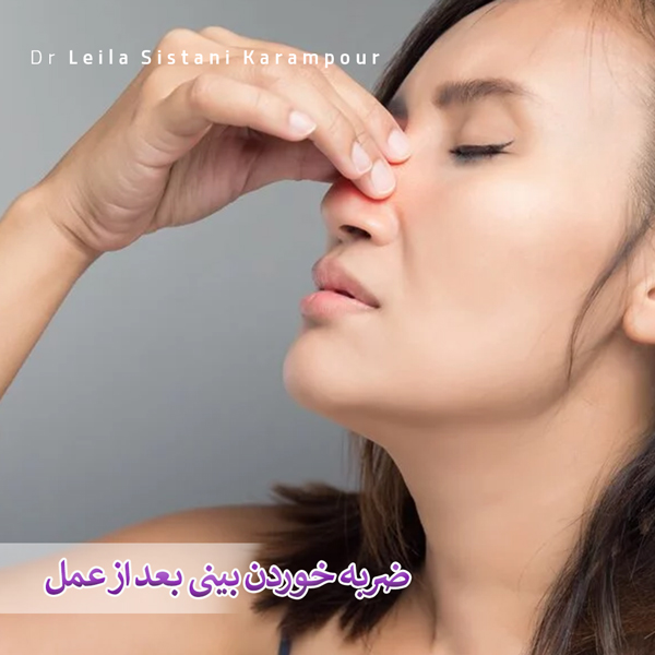 ضربه خوردن بینی بعد از عمل _ دکتر لیلا سیستانی