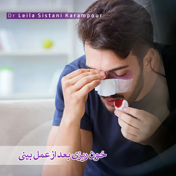 خون ریزی بعد از عمل بینی _ دکتر لیلا سیستانی