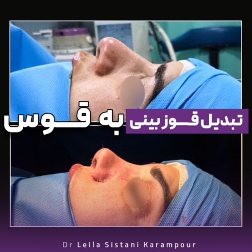 جراحی-بینی-29