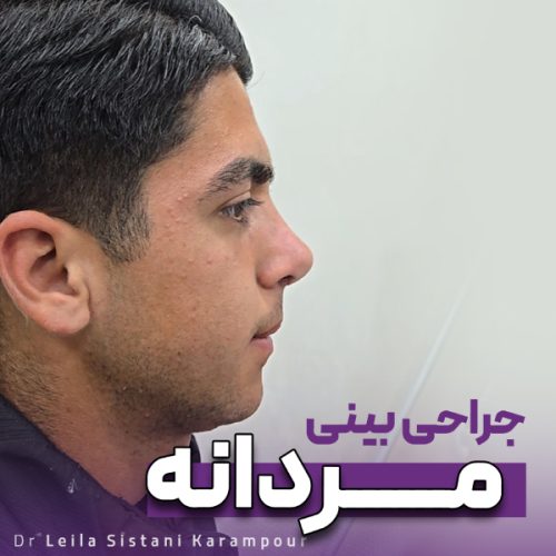 جراحی-بینی-30