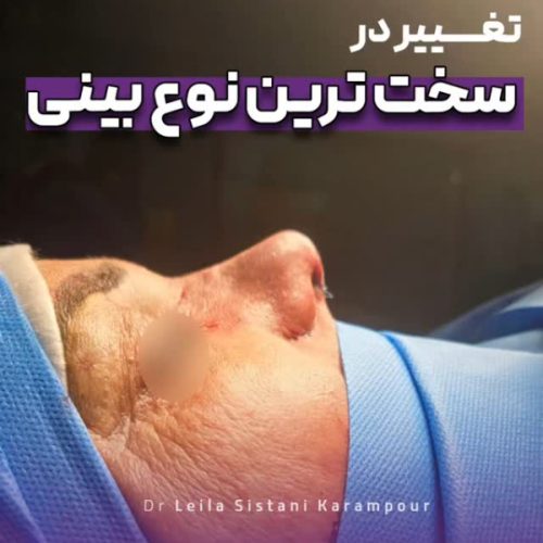 جراحی-بینی-31 