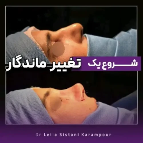جراحی-بینی-37