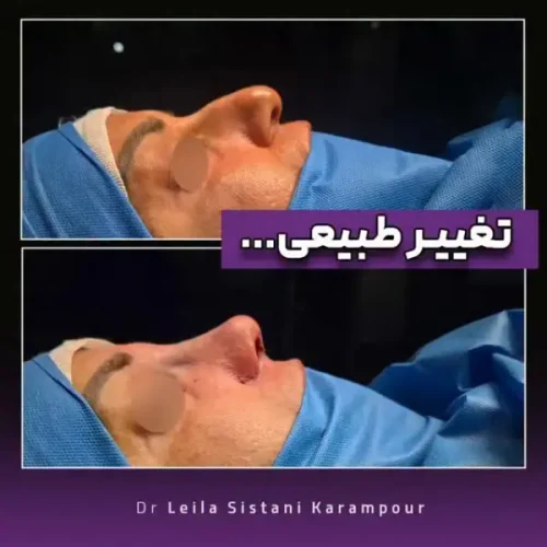 جراحی-بینی-38