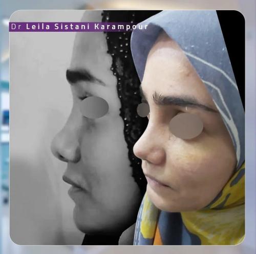 جراحی-بینی-7